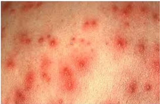 A Young Man With Ecchymotic Patches All Over The Body